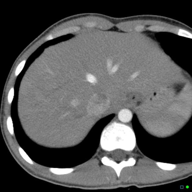 Traumatic Liver Laceration: Importance of Portal Venous Phase CT (Vết rách gan do chấn thương – tầm quan trọng của chụp CT thì tĩnh mạch cửa)