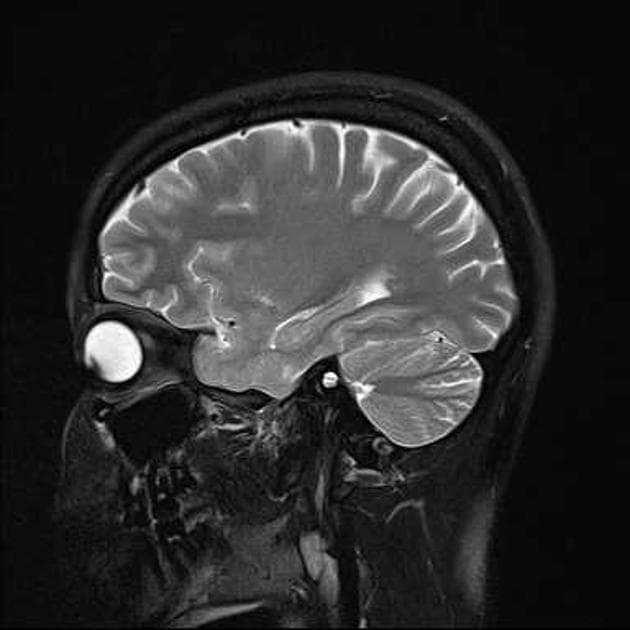 Pituitary macroadenoma