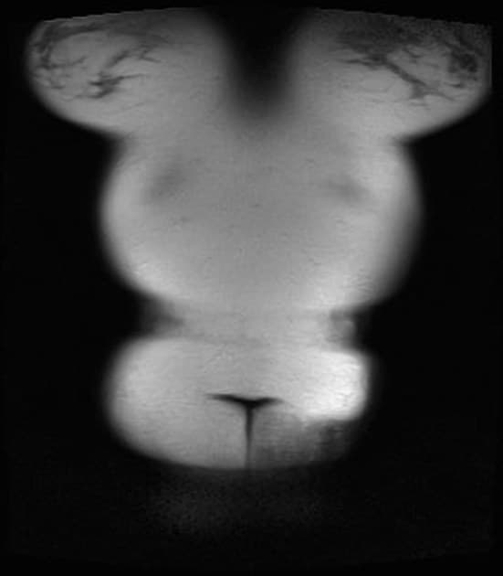 Focal Nodular Hyperplasia of the Liver (Tăng sản khu trú dạng nốt)