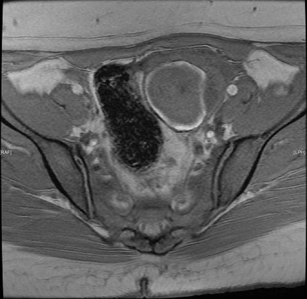 Adenomyosis with endometrioma