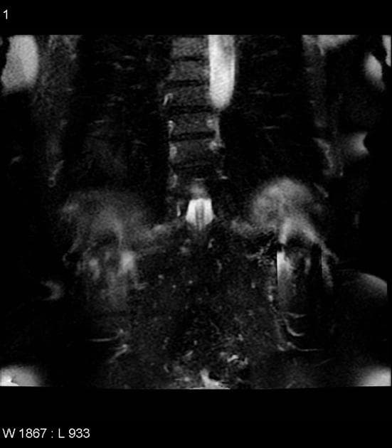 Adrenal Myelolipoma (U tủy mỡ tuyến thượng thận)