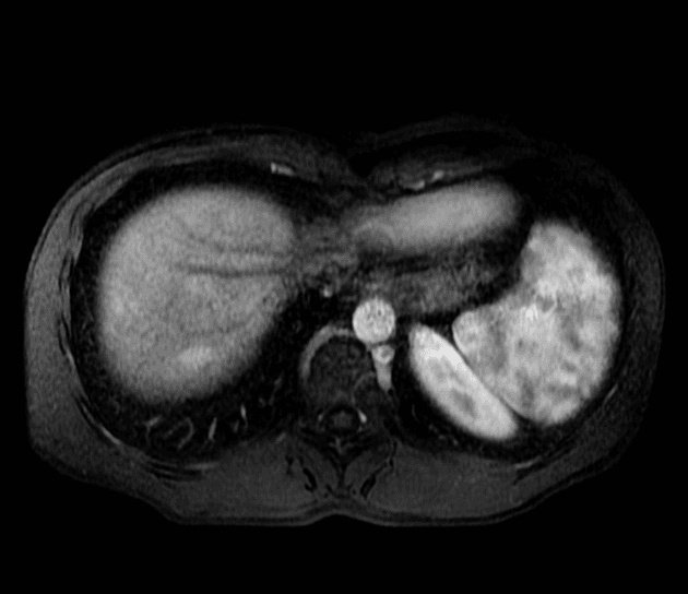 Focal nodular hyperplasia - multiple