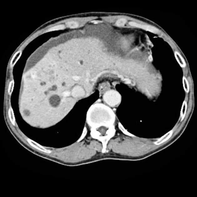 Cholangiocarcinoma with Biliary Obstruction and Portal Vein Invasion (Ung thư đường mật)
