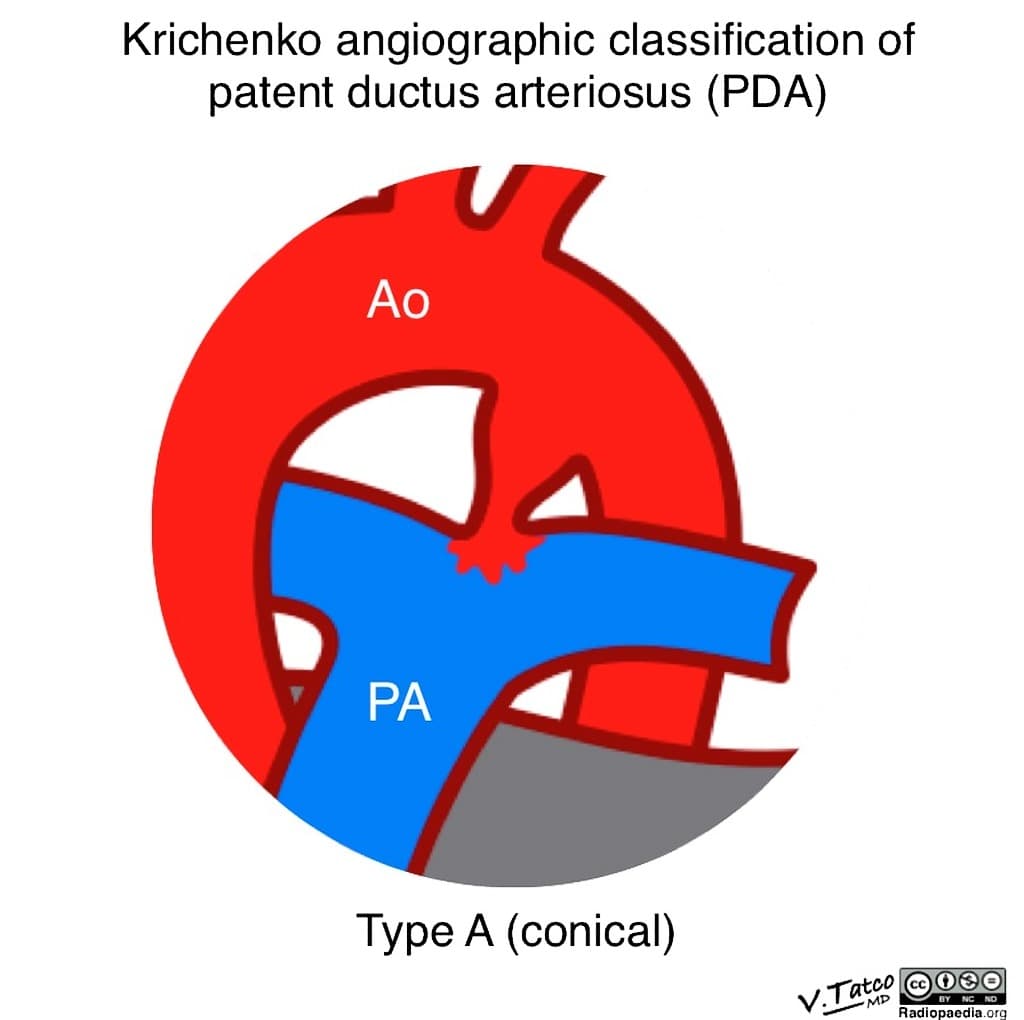 Krichenko angiographic classification of patent ductus arteriosus (illustration)