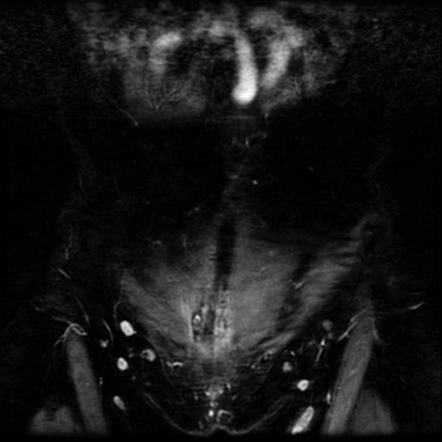 Endometriosis - scar