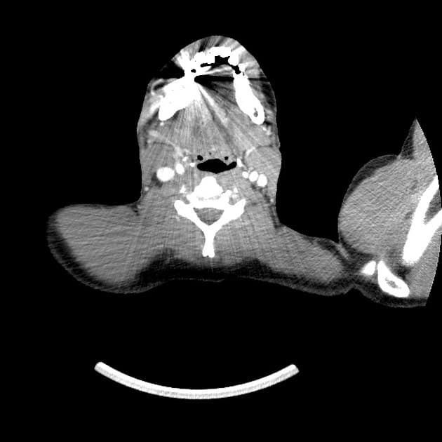 Traumatic Rib Fractures, Pneumothorax, and Liver Laceration (Gãy xương sườn do chấn thương, tràn khí màng phổi và rách gan)