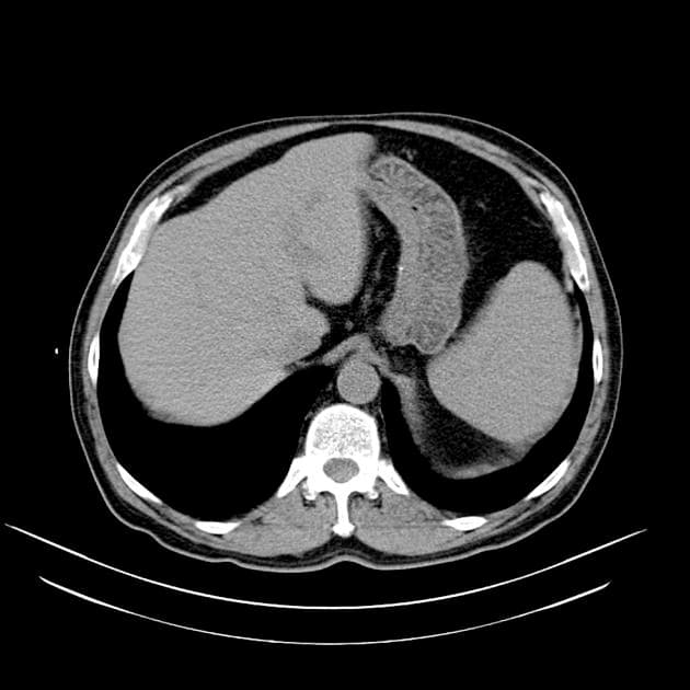 Renal Abscess (Áp xe thận)