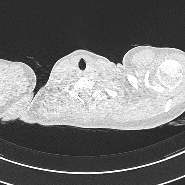 Post-Primary Tuberculosis (Lao phổi thứ phát)