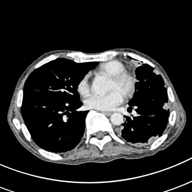 Retroperitoneal Liposarcoma (U mỡ sau phúc mạc)