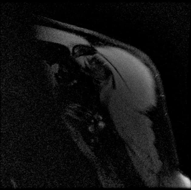 Recurrent dislocation of the shoulder