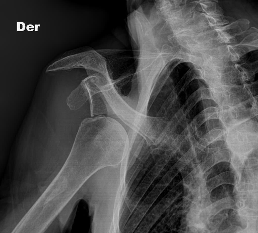 Anterior shoulder dislocation