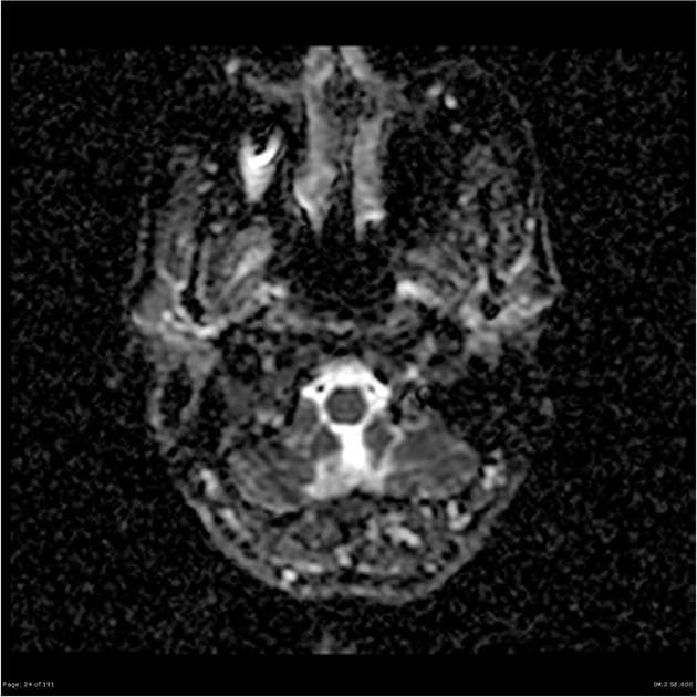 Multiple Sclerosis (Xơ cứng rải rác)