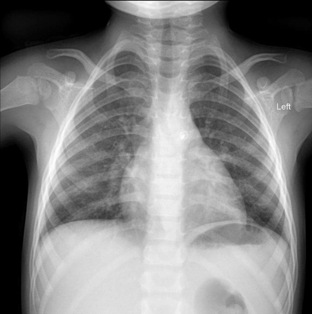 Patent ductus arteriosus closure device