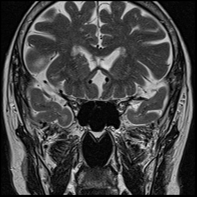 Spindle cell oncocytoma of the pituitary gland