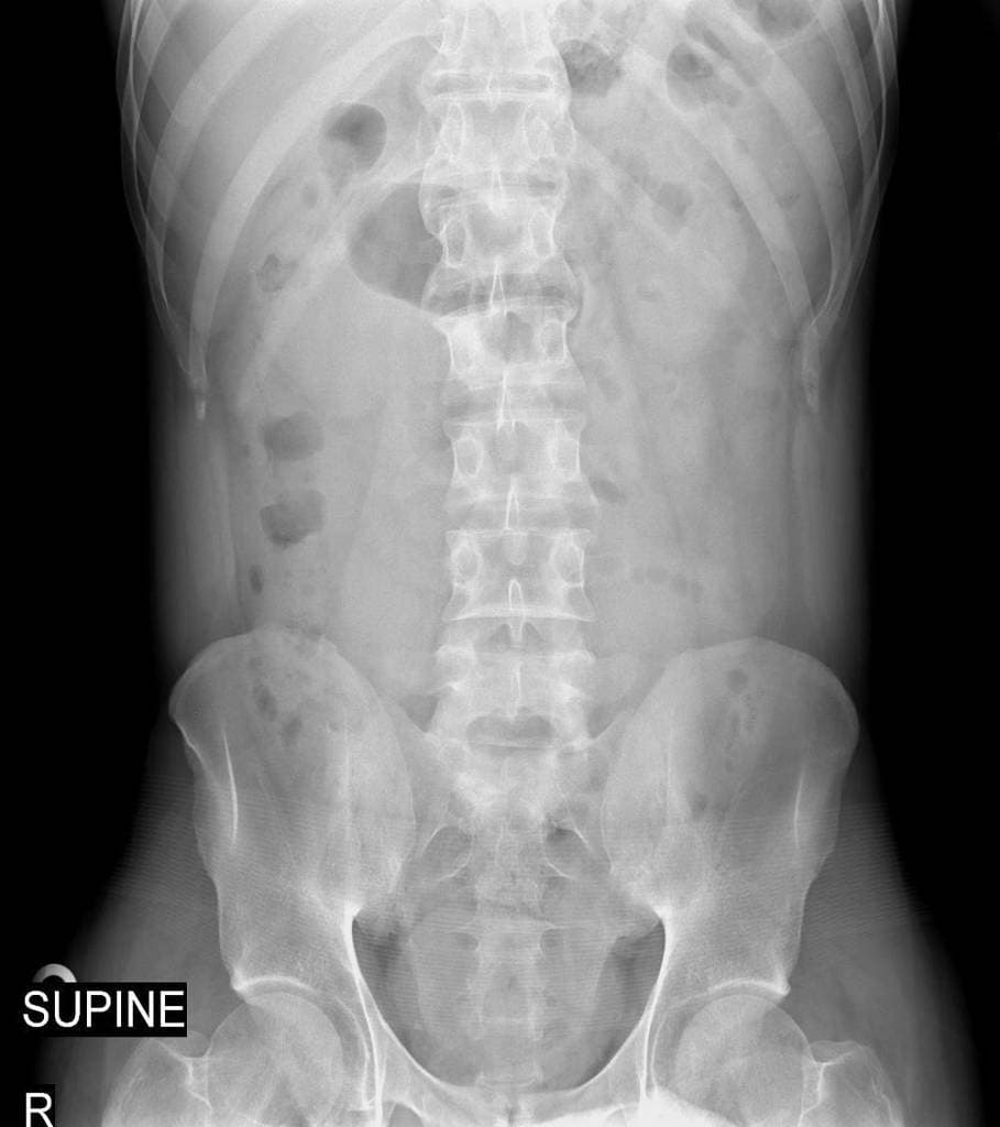 Crohn disease and ankylosing spondylitis