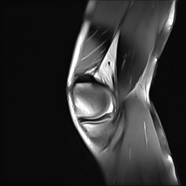 Flipped Meniscus (Thùy lật ngược)