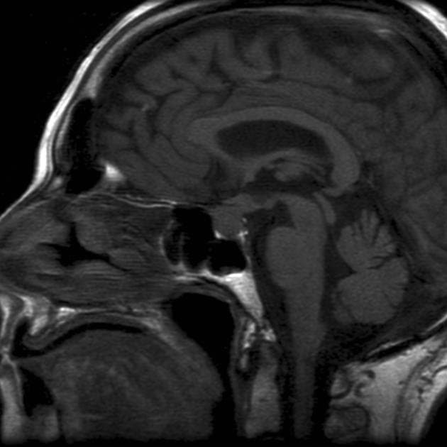 Pituitary metastasis