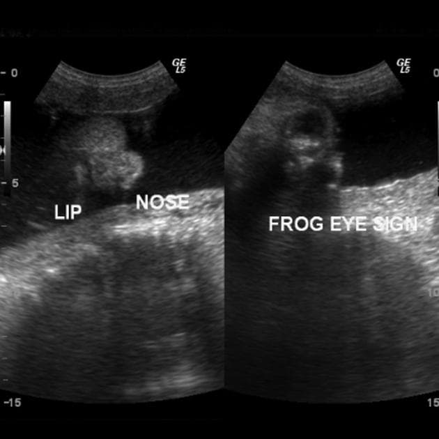 Acrania-Exencephaly Sequence (Chuỗi hội chứng acrania-exencephaly)
