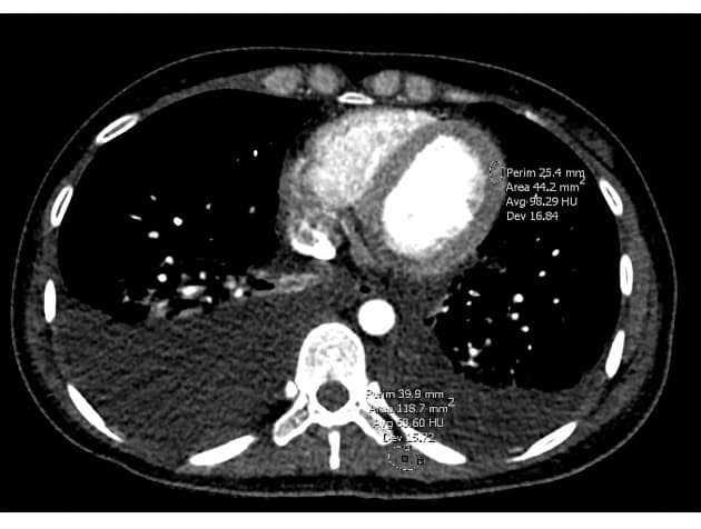 Acute myocarditis