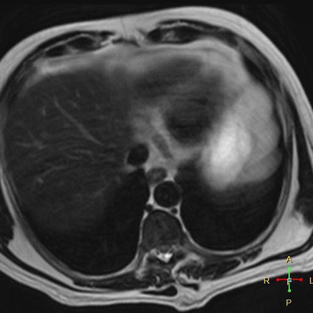 Pancreatic Adenocarcinoma (Ung thư biểu mô tuyến tụy)