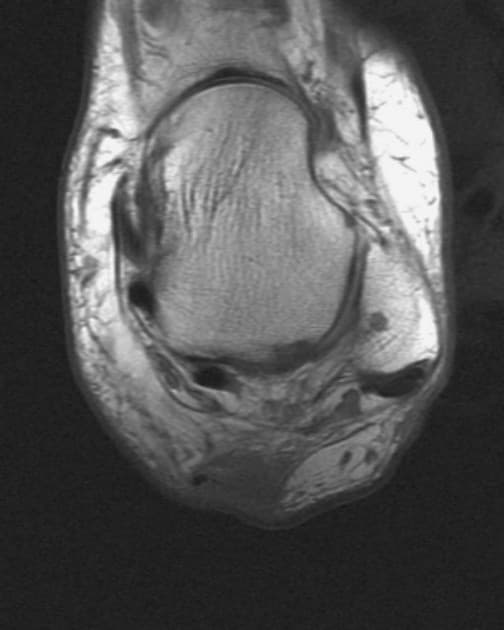 Achilles Tendon Tear (Vỡ gân gót (Achilles tendon tear))