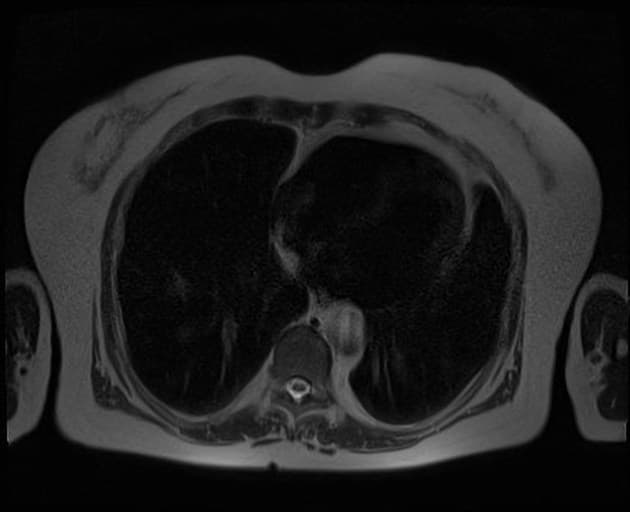 Gallstones: CT vs MRI