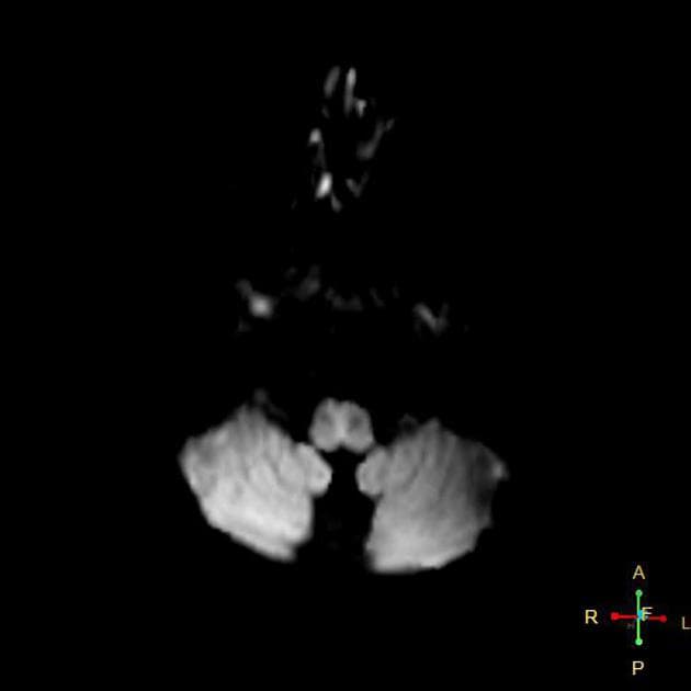 Glioblastoma NOS (corpus callosum)