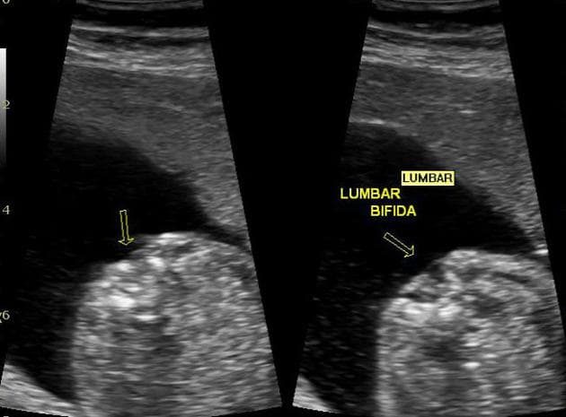 Myelomeningocele (Myelomeningocoele)