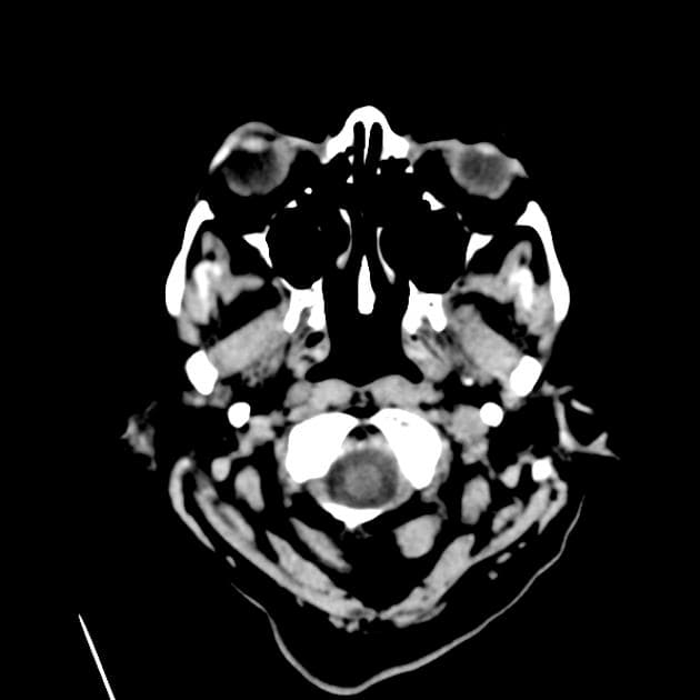 Brain metastases from breast cancer