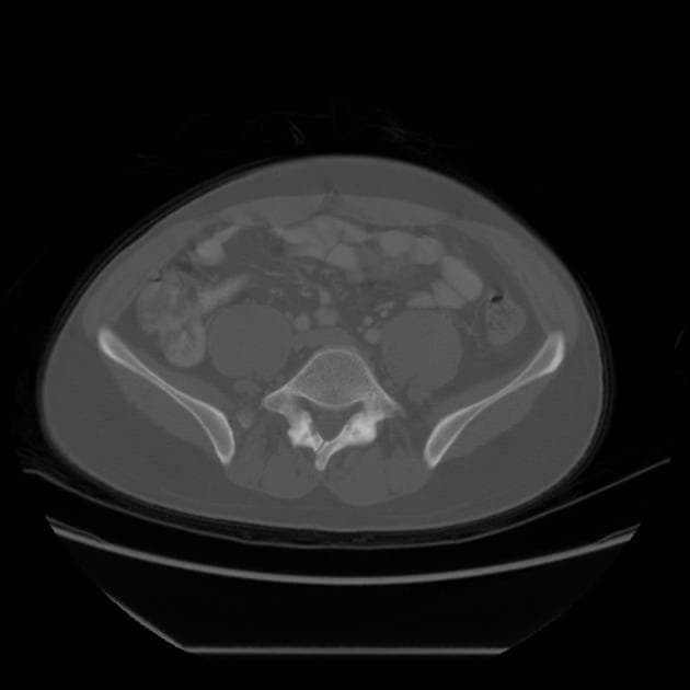 Spina bifida occulta (Gai đôi sống ẩn)