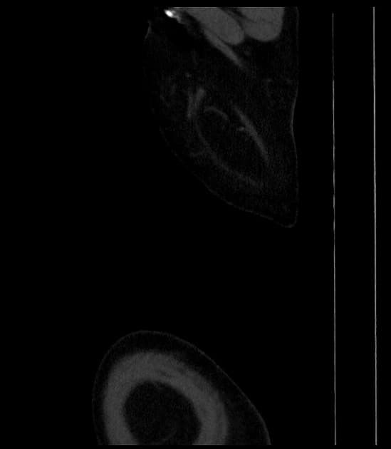 Ruptured Stanford type A aortic dissection