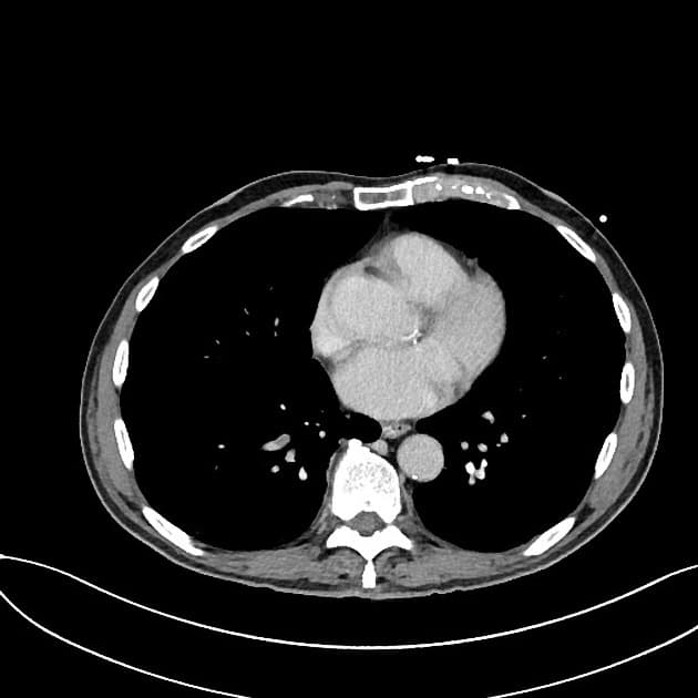 Metastatic Pancreatic Adenocarcinoma of the Tail with Colon Obstruction (Ung thư biểu mô tuyến di căn ở đuôi tụy kèm tắc ruột già)