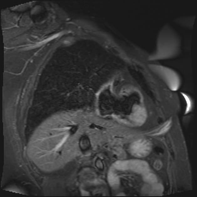 Intracardiac Metastasis from Known Renal Cell Carcinoma (Di căn nội tâm thất từ ung thư tế bào thận đã biết)