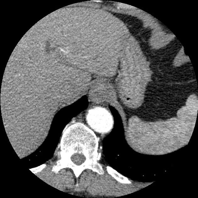 Pancreatic Adenocarcinoma of the Uncinate Process (Ung thư biểu mô tuyến tụy - mỏm móc)