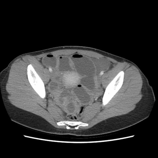 Endometriosis causing recurrent small bowel obstruction