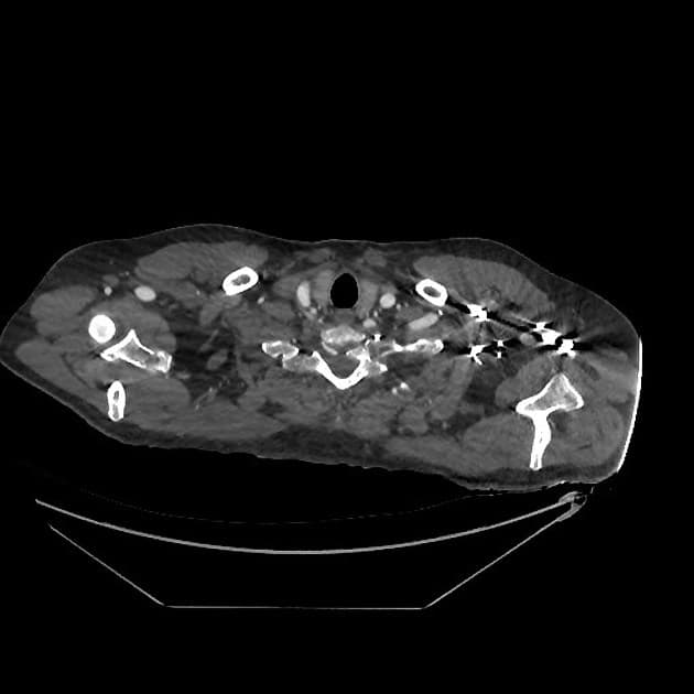 Patent ductus arteriosus