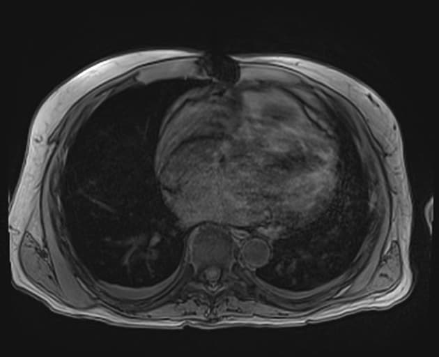 Ductal Cholangiocarcinoma (Ung thư biểu mô tế bào gan dạng ống mật (Ductal cholangiocarcinoma))