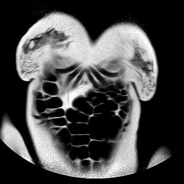 Von Hippel-Lindau Disease - Pancreatic Manifestations (Bệnh Von Hippel-Lindau - biểu hiện tụy)