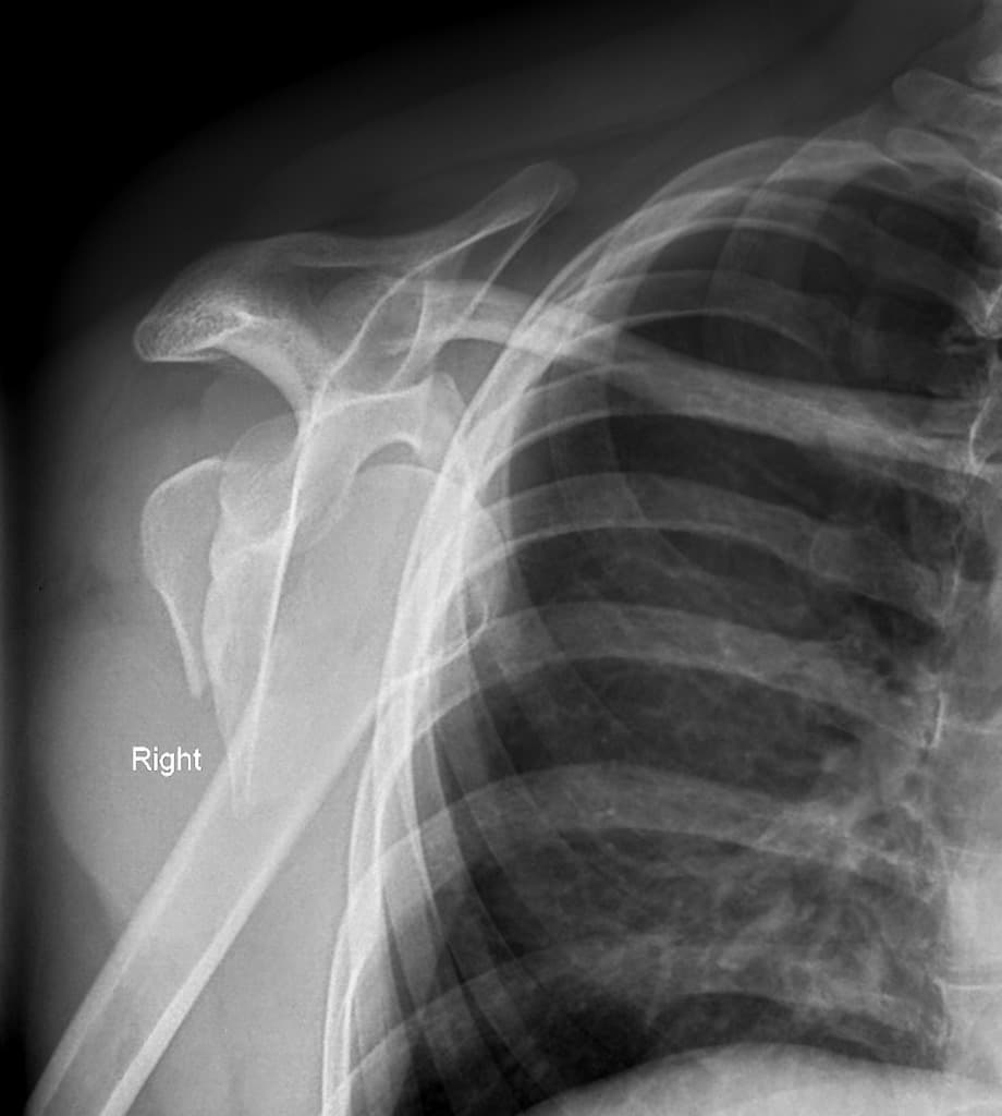 Bilateral anterior shoulder fracture-dislocations