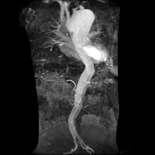 Aortic dissection - Stanford A / DeBakey I