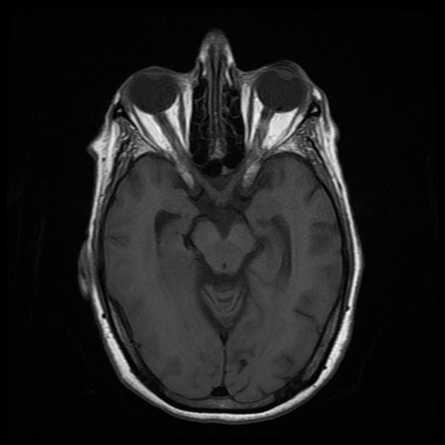 Glioblastoma NOS