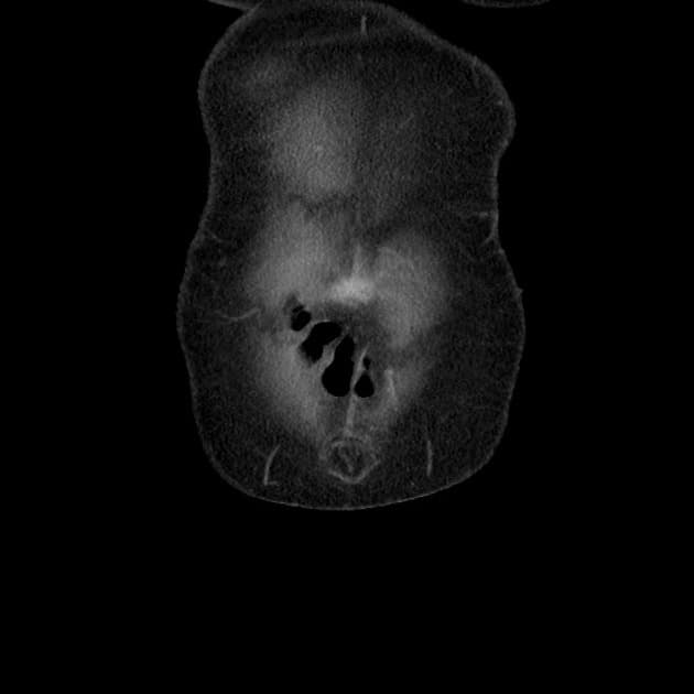 Pancreatic Sarcoidosis (U sarcoid ở tụy)