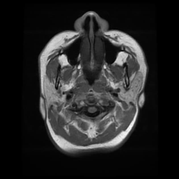 Suprasellar meningioma