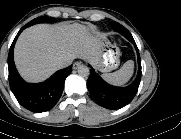 Von Hippel-Lindau Disease with Pancreatic and Renal Involvement (Bệnh Von Hippel-Lindau)