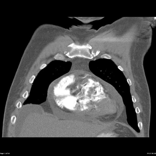 Right ventricular thrombus