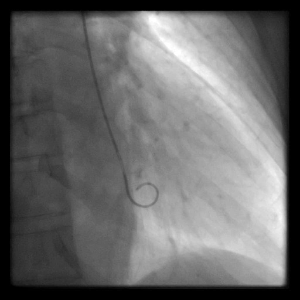 Takotsubo cardiomyopathy