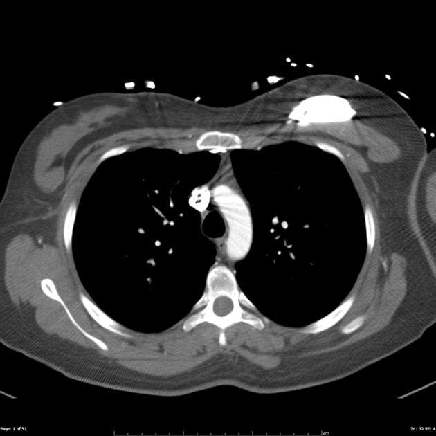 Hypertrophic obstructive cardiomyopathy (HOCM)