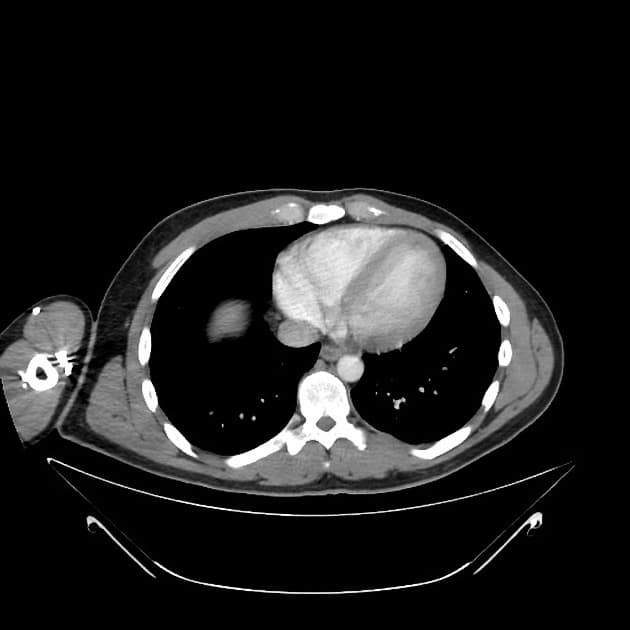 Bile Leak from Traumatic Liver Laceration (Rò dịch mật do vỡ gan do chấn thương)