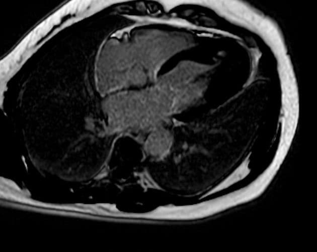Hypertrophic cardiomyopathy - apical pattern with midventricular obstruction