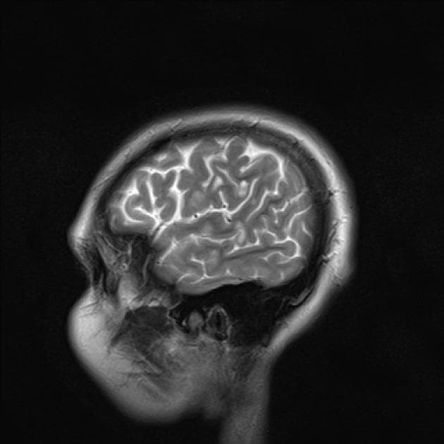 Multiple Sclerosis (Xơ cứng rải rác)